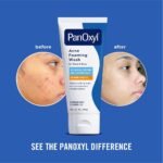 ⁦PANOXYL- غسول بان أوكسيل الرغوي لعلاج حب الشباب، بنزويل بيروكسيد 10%، للوجه والجسم، 85 غرام⁩ - الصورة ⁦4⁩